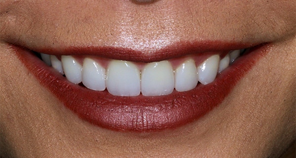 porcelain veneers after