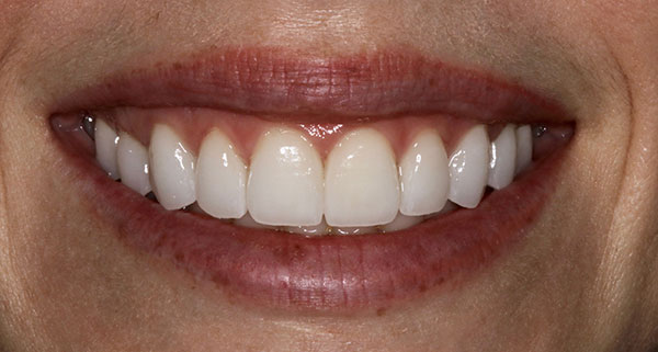 porcelain veneers after