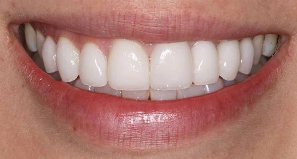 porcelain veneers after