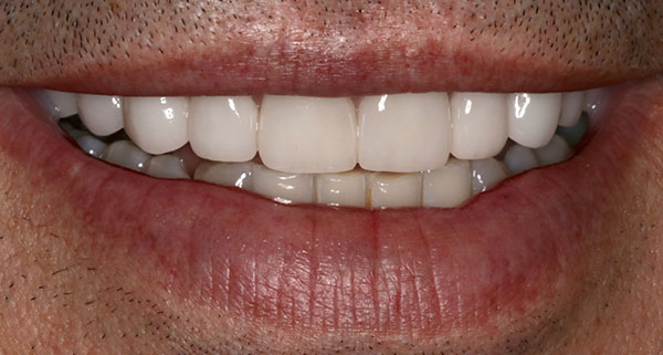 porcelain veneers after