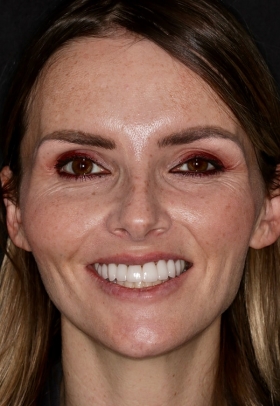 Porcelain Veneers After