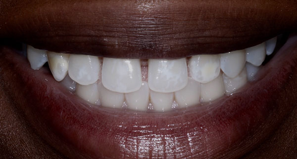 porcelain veneers before