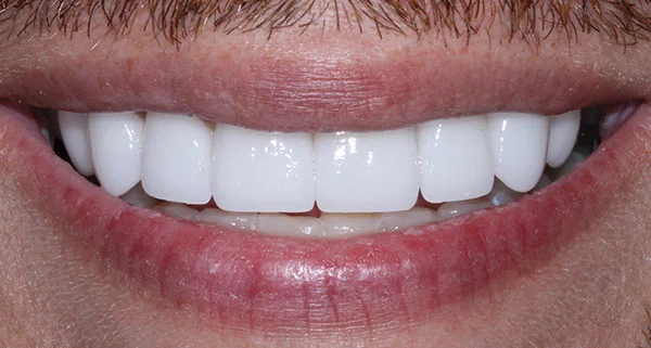 porcelain veneers after