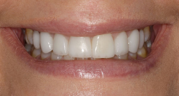 porcelain veneers before