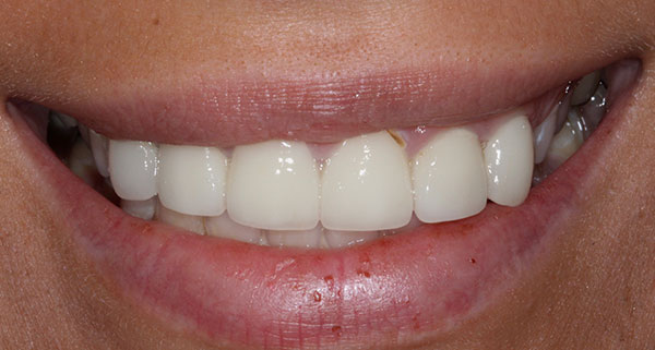 porcelain veneers before