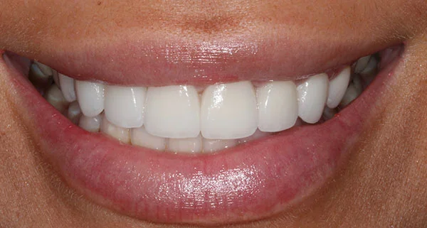 porcelain veneers after