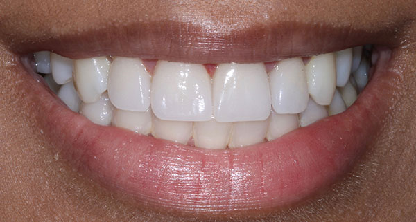 porcelain veneers after