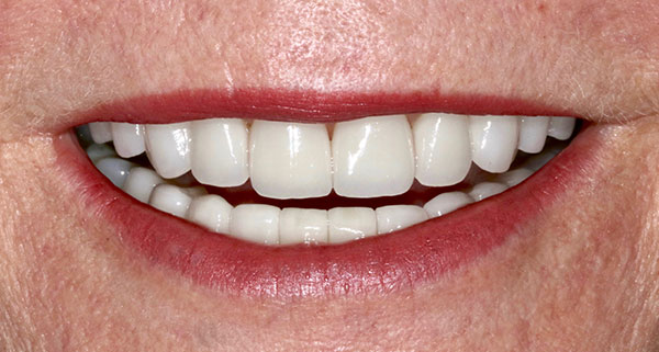 porcelain veneers after