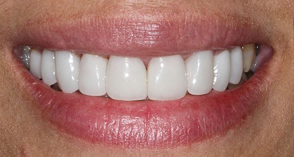 porcelain veneers after