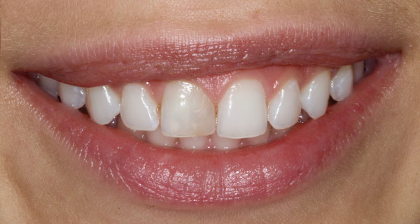 porcelain veneers before