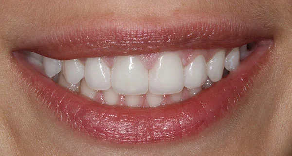 porcelain veneers after