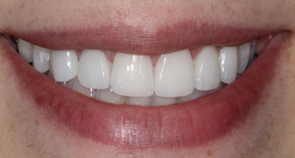 porcelain veneers after