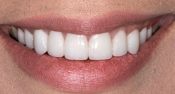 porcelain veneers after