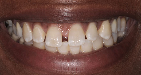 porcelain veneers before