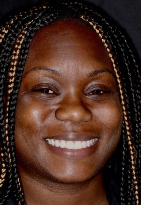 Porcelain Veneers After