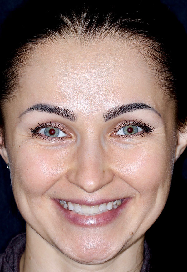 Porcelain Veneers Photos NYC - Portrait Before Women Patient 20