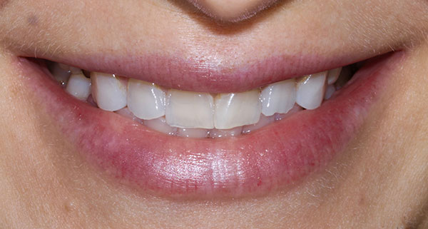 porcelain veneers before