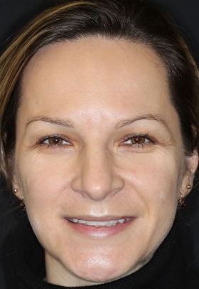 Porcelain Veneers After