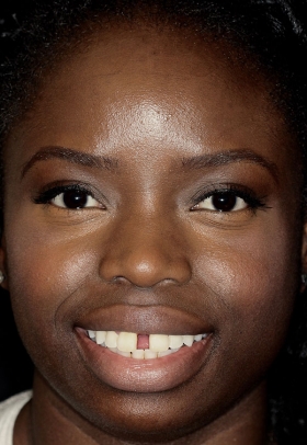 Porcelain Veneers Before