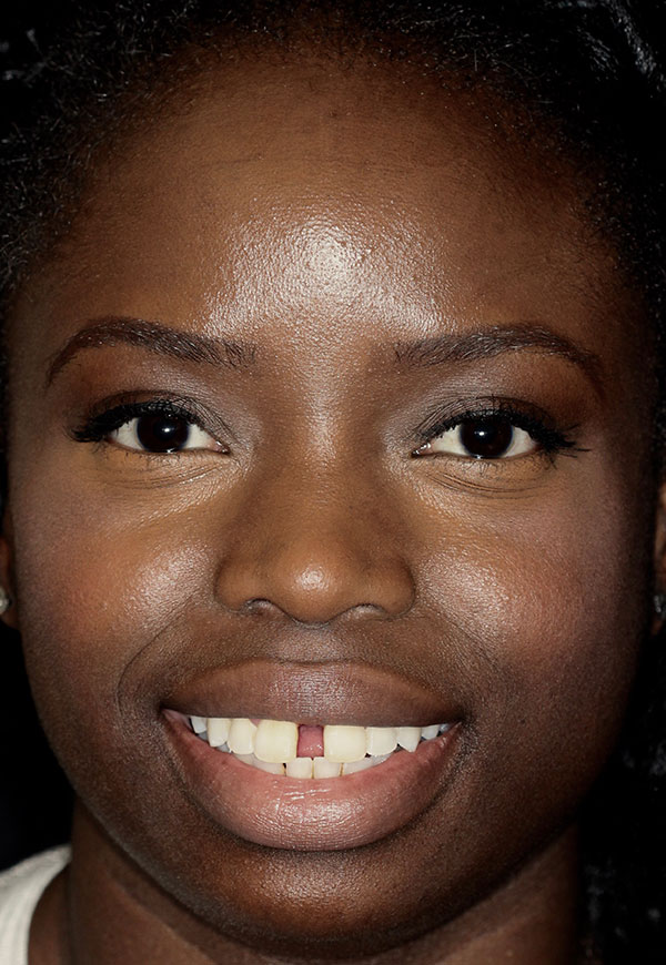 Porcelain Veneers Photos NYC - Portrait Before Women Patient 27