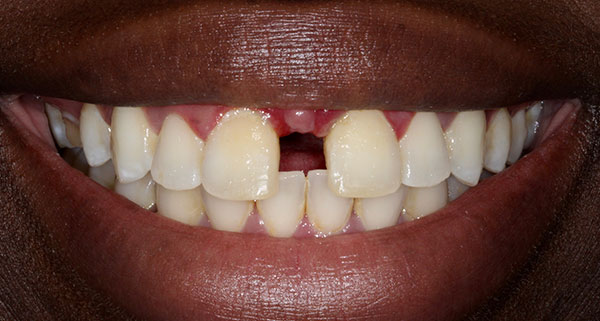 porcelain veneers before