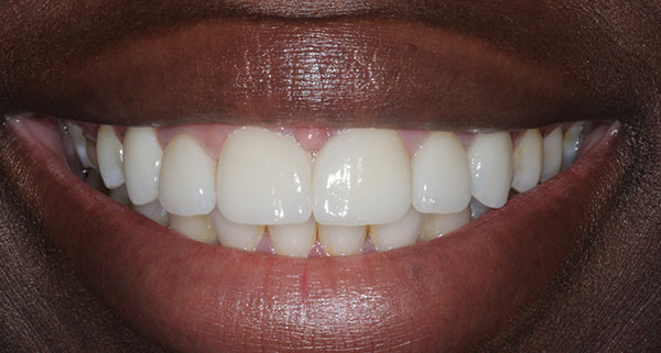 porcelain veneers after