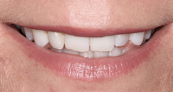 porcelain veneers before