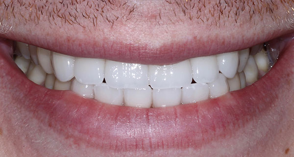 porcelain veneers after