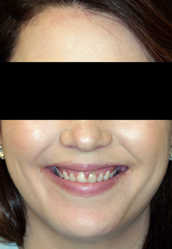 porcelain veneers before