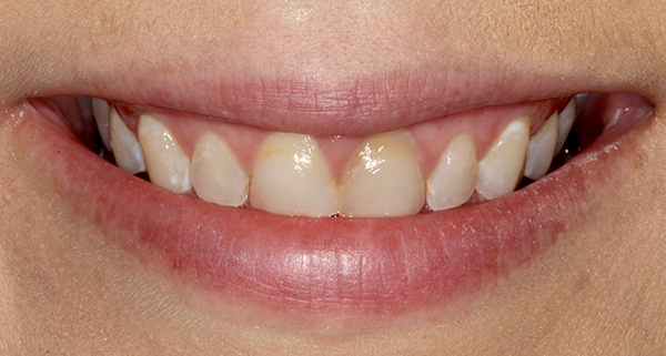 Porcelain Veneers Photos NYC - Smile Before Women Patient 3