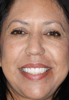 Porcelain Veneers After