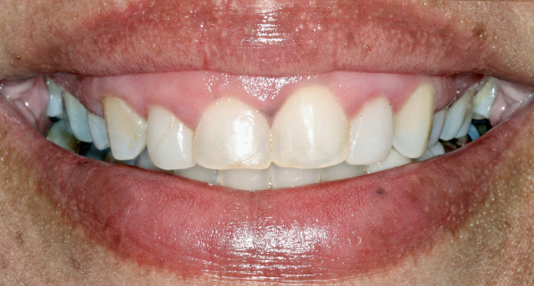 porcelain veneers before