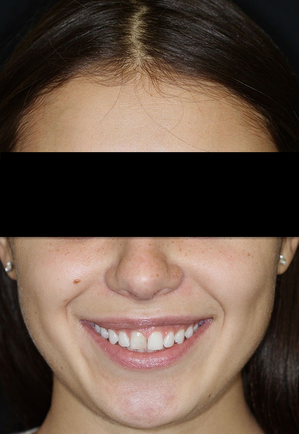 porcelain veneers before