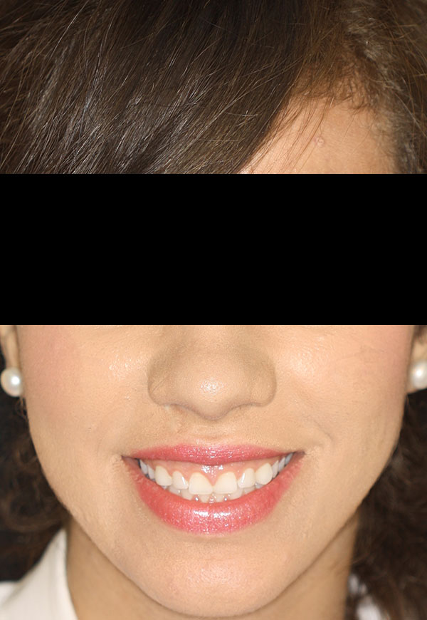 porcelain veneers before