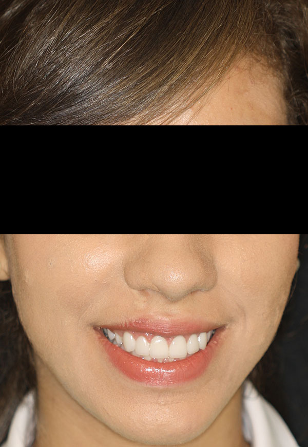 porcelain veneers after