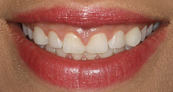 porcelain veneers before